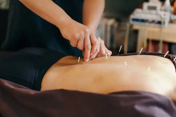 Acupuncture session in a Japanese medical study. Young woman is lying down while the operator inserts the needles in the back of the patient
