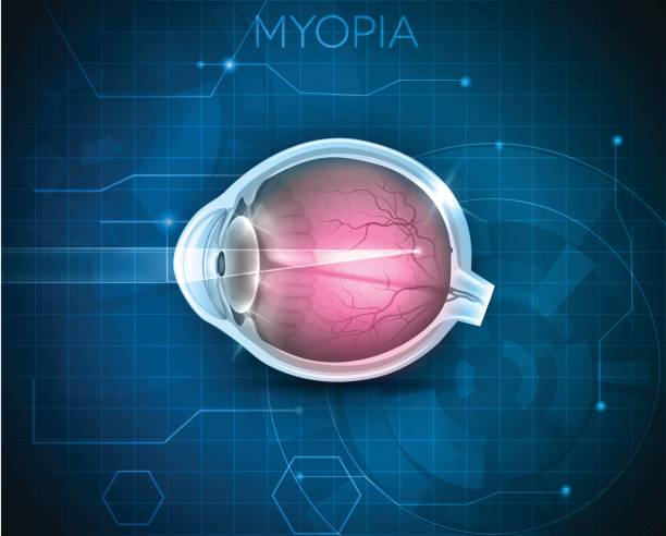 Myopia Transparent 490+ Myopia Diagram Stock Illustrations, Royalty-Free Vector Graphics ...