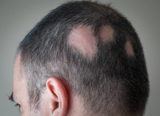 alopecia aerata - spot kahlheit - alopezie stock-fotos und bilder