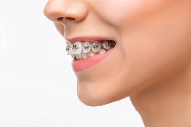 istock Beautiful young woman with teeth braces 653875992
