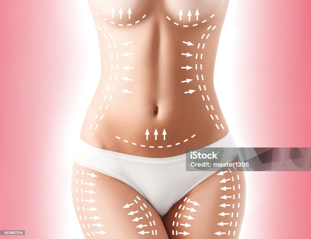 Die Entfernung von Zellulitis planen. Weiße Markierungen junge Frau Körper - Lizenzfrei Plastische Chirurgie Stock-Foto