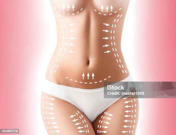 Die Entfernung Von Zellulitis Planen Weiße Markierungen Junge Frau Körper Stockfoto und mehr Bilder von Plastische Chirurgie