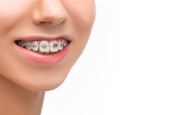 istock Beautiful young woman with teeth braces 653896606