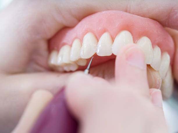 dental technician is working with porcelain teeth in a cast molde in dental laboratory - dentures imagens e fotografias de stock