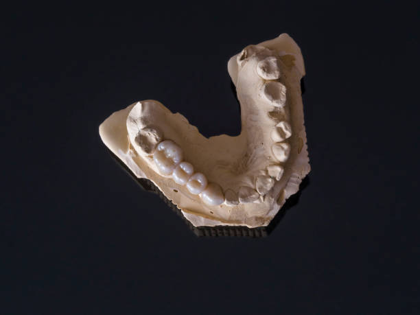 istock Monolithic zirconia restorations  implant supported with the ceramic load in vestibular, back background 654248062