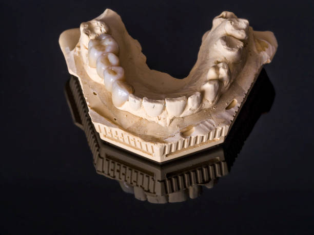 istock Monolithic zirconia restorations  implant supported with the ceramic load in vestibular, back background 654248178