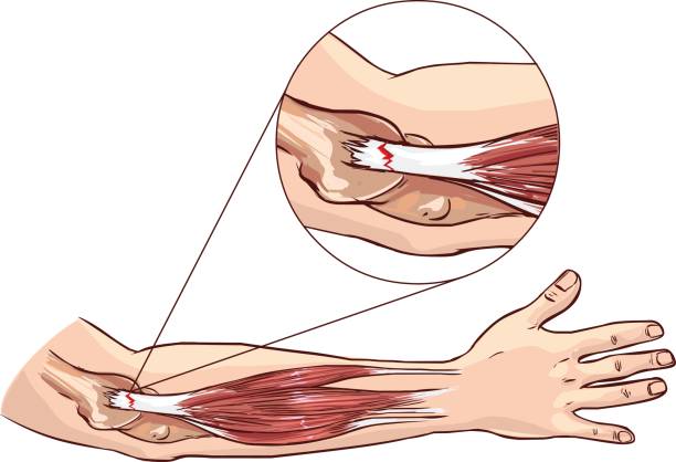 Tennis elbow - tear in the common extensor tendon of the arm vector art illustration