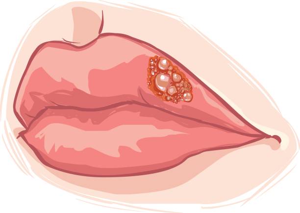 white background vector illustration of a lip herpes vector art illustration