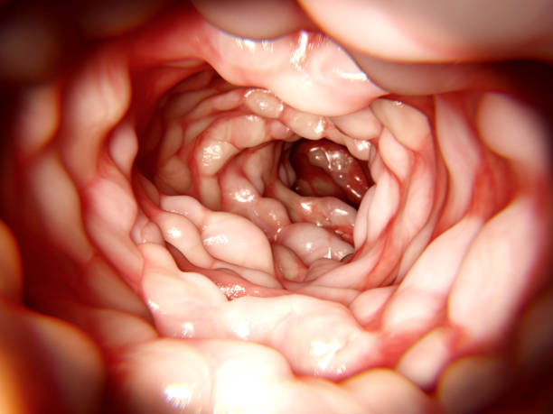 istock Intestine affected by Morbus Crohn 654756614