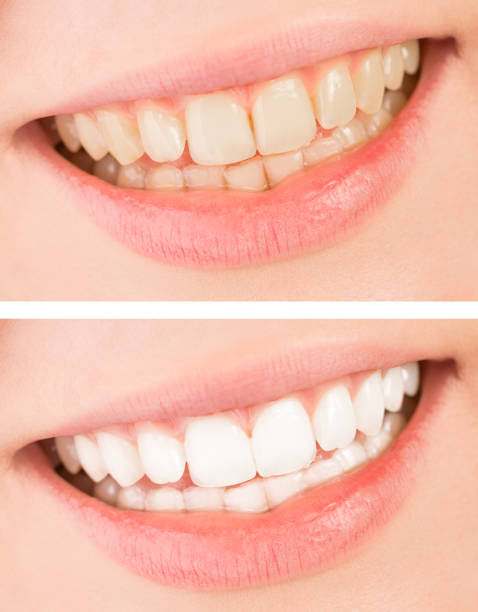 istock Whiten - smile and teeth whitening treatment before and after. 655144832