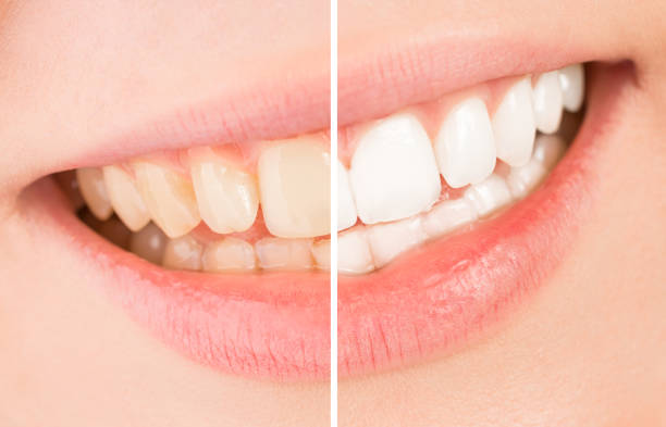 istock Whiten - smile and teeth whitening treatment before and after. 655144842