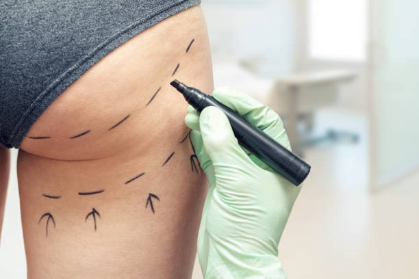 plastic surgeon marking womans body for plastic surgery - nádega imagens e fotografias de stock