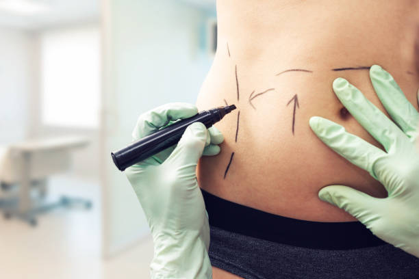 chirurg plastyczny oznaczający ciało kobiety do zabiegu chirurgicznego - liposuction zdjęcia i obrazy z banku zdjęć