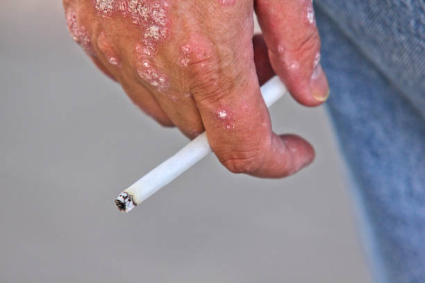 Person with psoriasis on it's hand, holding a lit cigarette between fingers, closeup stock photo