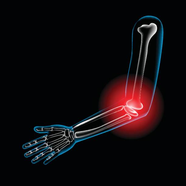 Arm bone and finger bone,pain,x ray Arm bone and finger bone,pain,x ray x ray results stock illustrations