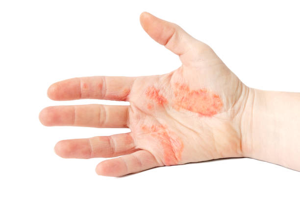 Hand Eczema Close-up photo of a hand suffering of eczema dermatitis photos stock pictures, royalty-free photos & images