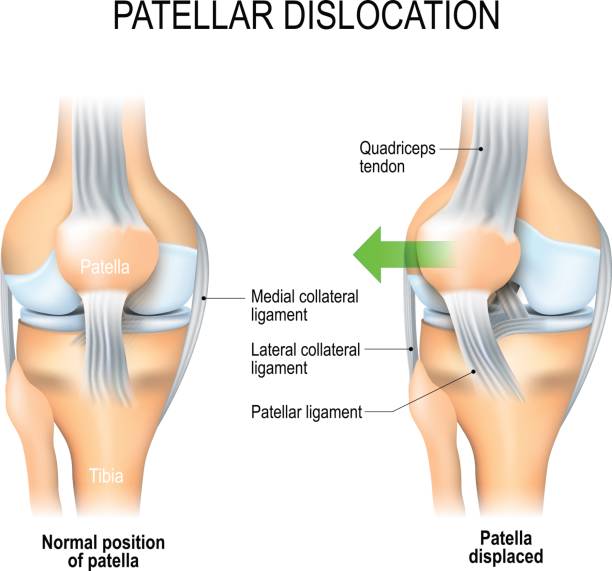 ilustraciones, imágenes clip art, dibujos animados e iconos de stock de luxación de la rótula - cruciate ligament