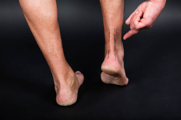 thermal burn of second degree injury of skin