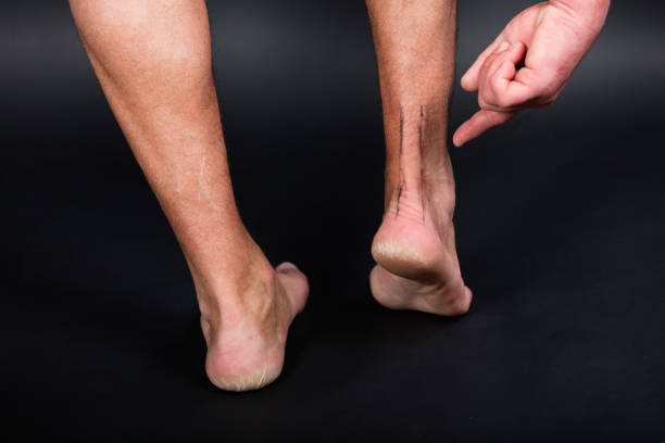 Right foot with drawing of achilles tendon stock photo