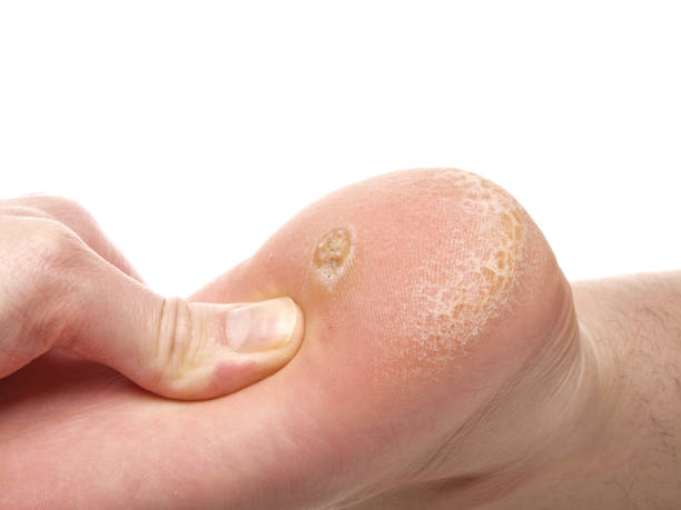 Dry skin under foot stock photo