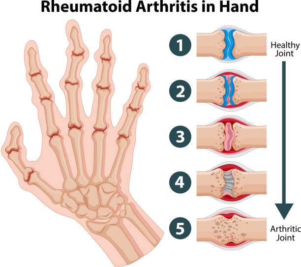 диаграмма, показывающая ревматоидный артрит в руке - human skeleton body the human body pain stock illustrations