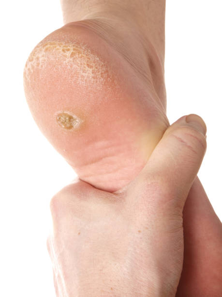 Dry skin under foot stock photo