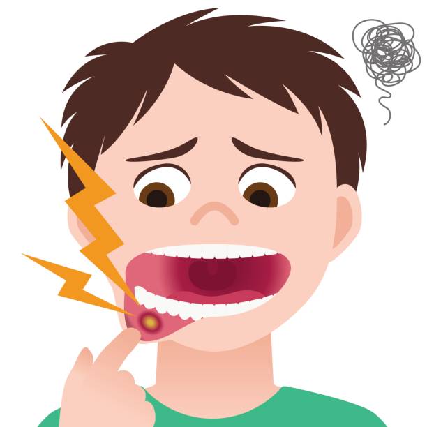 stomatitis, mundgeschwür, entzündung der mundschleimhaut, bild-darstellung - mucosa stock-grafiken, -clipart, -cartoons und -symbole