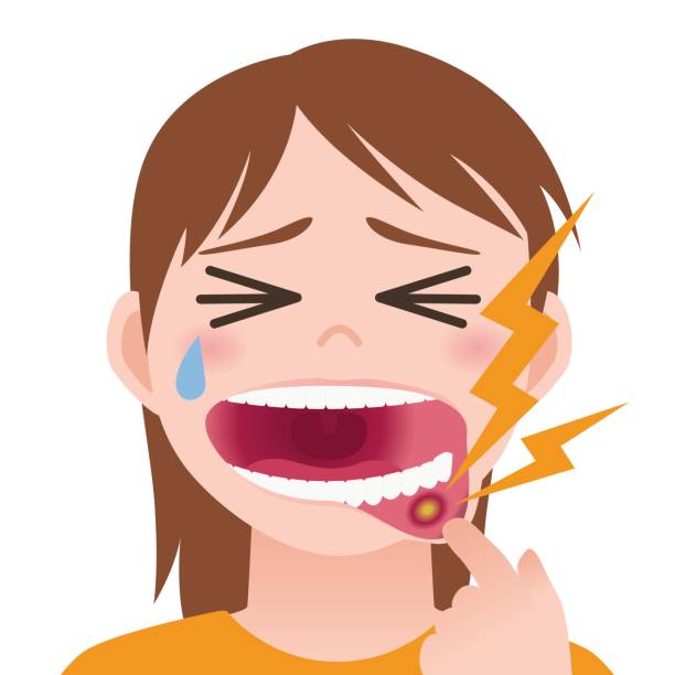 ilustrações de stock, clip art, desenhos animados e ícones de stomatitis, mouth ulcer, inflammation of the oral mucosa, image illustration - undernourishment