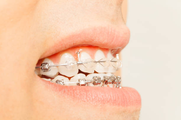 istock Profile view of braces for orthodontic treatment 657154290