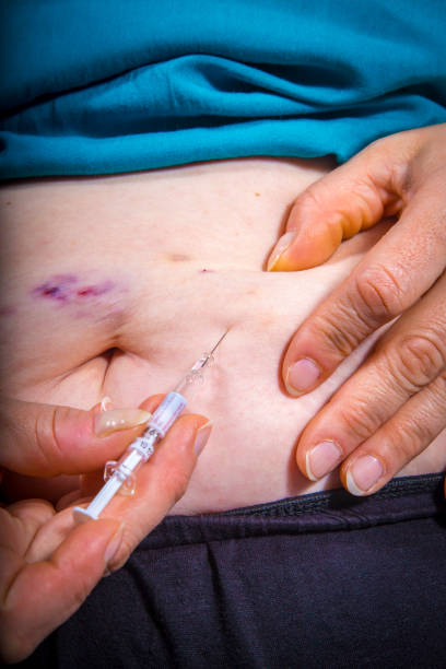Bruises from self Injecting medical therapy Adult woman self Injecting medical therapy with bruises on her stomach. Chemotherapy. Medical concept anabola steroider dosering stock pictures, royalty-free photos & images