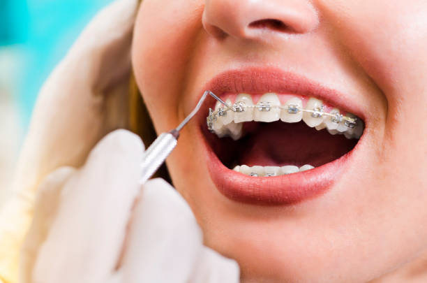 Closeup young woman checking her braces, smiling Closeup young woman checking her braces, smiling, dentist hand with tool adjusting rubbers on braces orthodontist consultation stock pictures, royalty-free photos & images