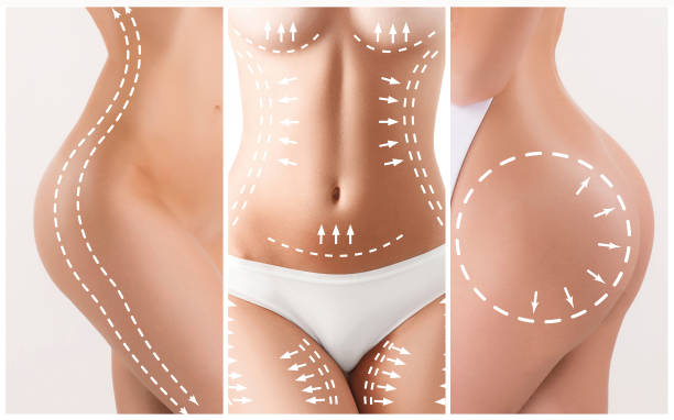 istock The cellulite removal plan. White markings on young woman body 657460950