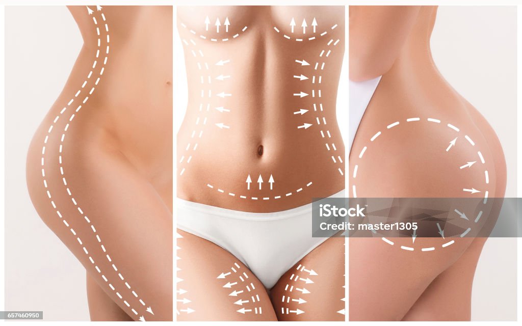 The cellulite removal plan. White markings on young woman body The cellulite removal plan. White markings on young woman body preparing for plastic surgery. Concept of slimming, liposuction, strand lifting Plastic Surgery Stock Photo