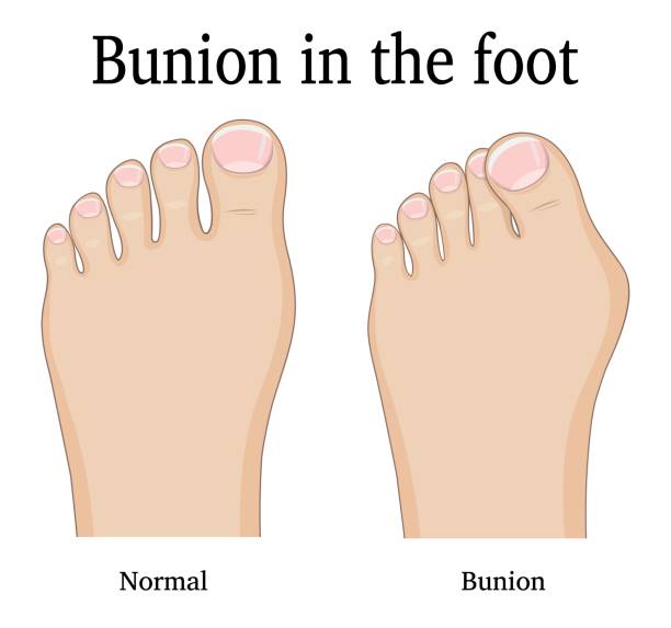 illustrazioni stock, clip art, cartoni animati e icone di tendenza di bunion ai piedi - human foot bunion pain human toe