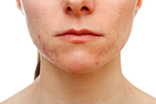 istock Adolescent girl suffering in acne 657489382