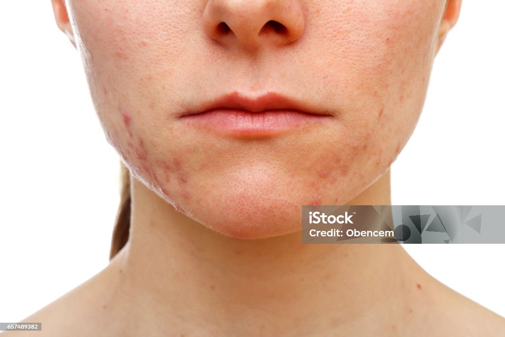 Adolescent girl suffering in acne Portrait of young girl with skin problem on isolated white background Acne Stock Photo