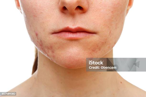 Adolescent Girl Suffering In Acne Stock Photo - Download Image Now - Acne, Scar, Chin