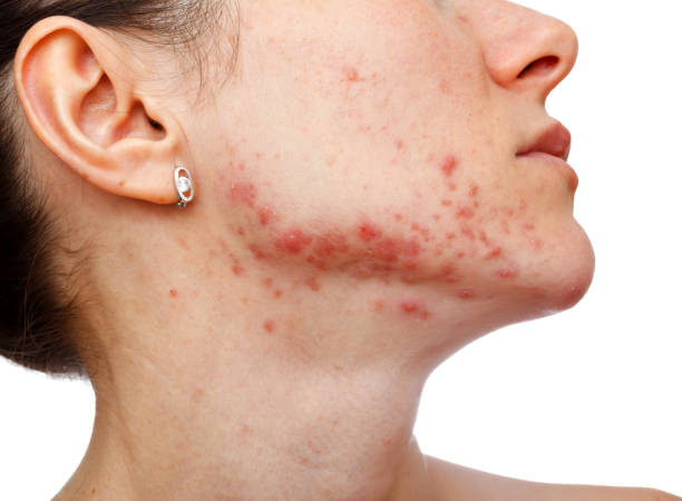 소녀 피부 문제와 - teenager body care adolescence human lips 뉴스 사진 이미지