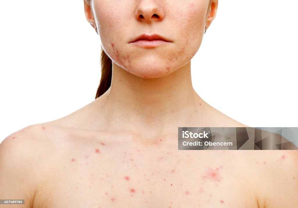 Skin problems Portrait of woman showing her pimples on isolated white background Acne Stock Photo