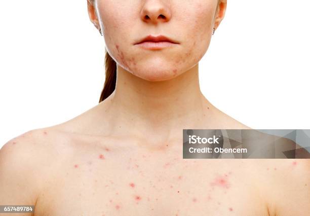 Skin Problems Stock Photo - Download Image Now - Acne, Chest - Torso, Adult