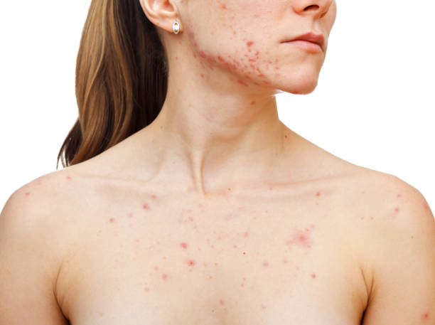 Skin problems Portrait of woman showing her pimples on isolated white background measles stock pictures, royalty-free photos & images