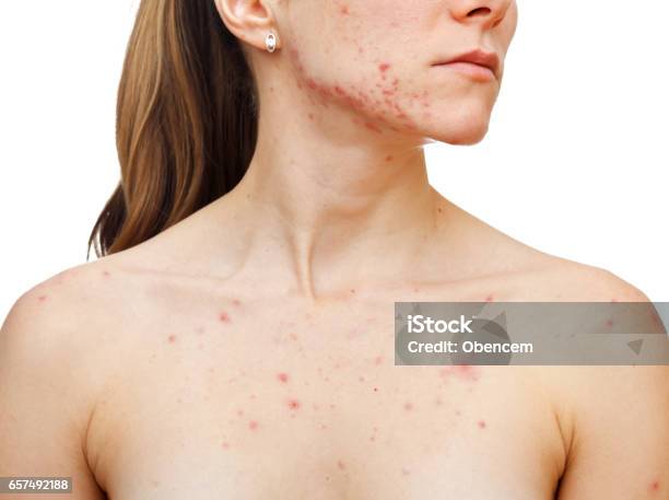 Skin Problems Stock Photo - Download Image Now - Acne, Chest - Torso, Adult