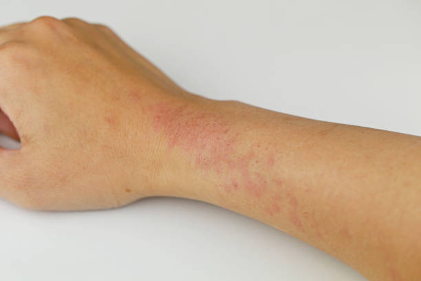 istock People who have allergies to hand 657563750