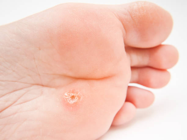 Person with callus located under foot stock photo