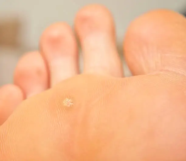 Callus and hyperkeratosis under a human foot, close-up, dried skin