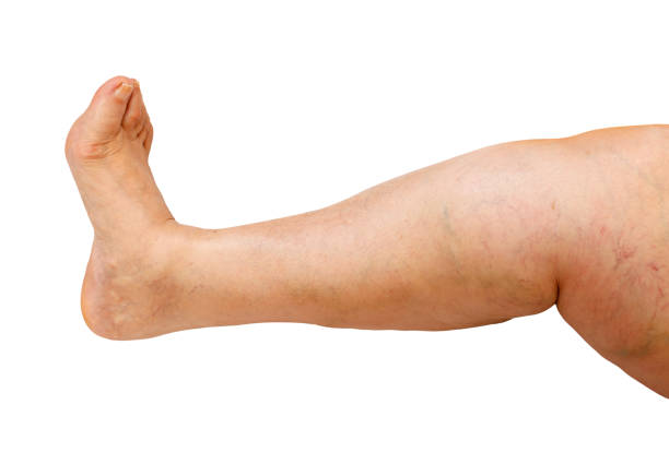 하부 사지 질환 - human leg smooth human skin human foot 뉴스 사진 이미지