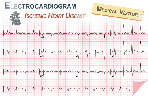 Electrocardiogram ( ECG , EKG ) of Ischemic Heart Disease ( Myocardial Infarction ) and Anatomy of heart icon