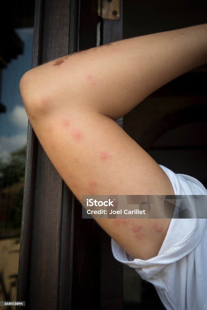 Bedbug bites on woman's arm Bedbug bites on woman's arm 36-hours after being bitten Bedbug Stock Photo