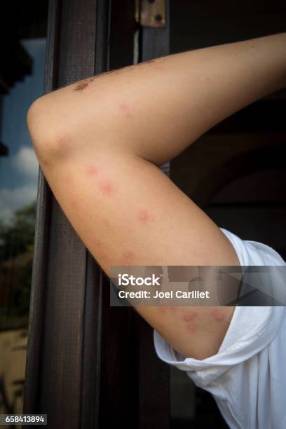 Bedbug Bites On Womans Arm Stock Photo - Download Image Now - Bedbug, Biting, Adult