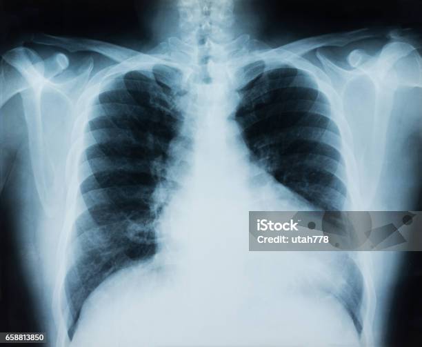 Radiografia Polmonare - Fotografie stock e altre immagini di Macchina per radiografie - Macchina per radiografie, Cancro ai polmoni, Immagine a raggi X